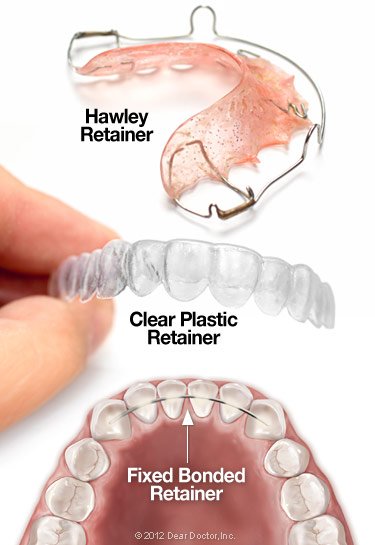 Types of Orthodontic Retainers 